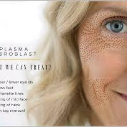 Plasma skin lift